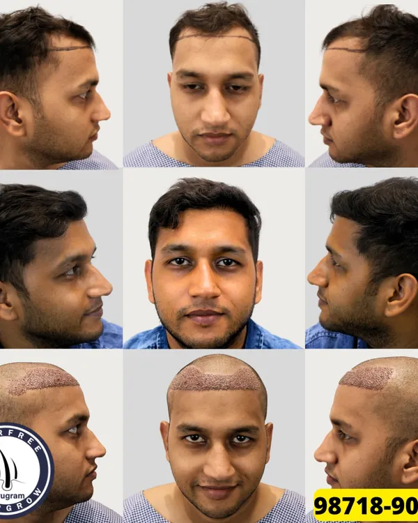 This collage shows the complete journey of one of my patients. You can see the pre-surgery hairline design, the scalp immediately after the FUE procedure with 1550 grafts, and the final, dense result after just 8 months. This is the kind of natural, life-changing transformation I aim for.