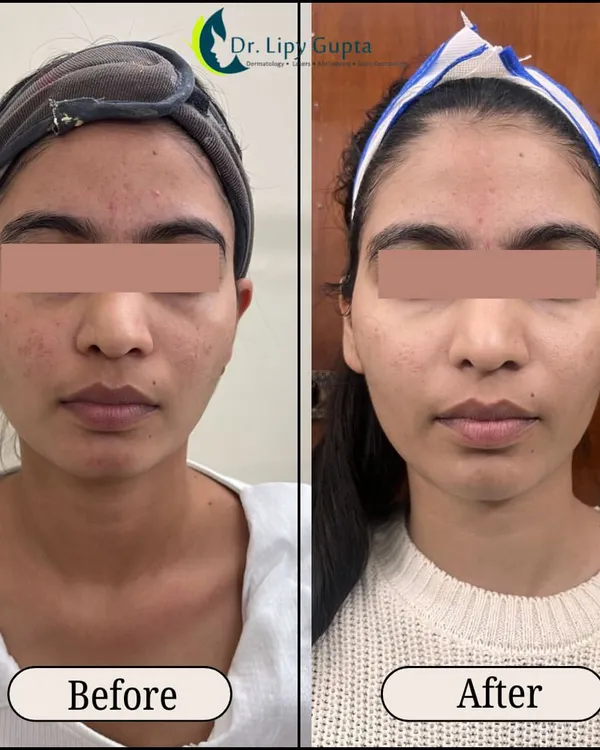 A clear before and after comparison showing the effectiveness of Morpheus8. Notice the improved skin texture, reduced redness and acne scarring, and a more defined and contoured jawline.