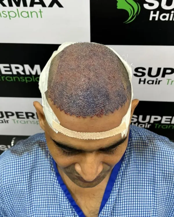 This is what the scalp looks like immediately after the DHI procedure. The grafts are densely packed to ensure a full look.