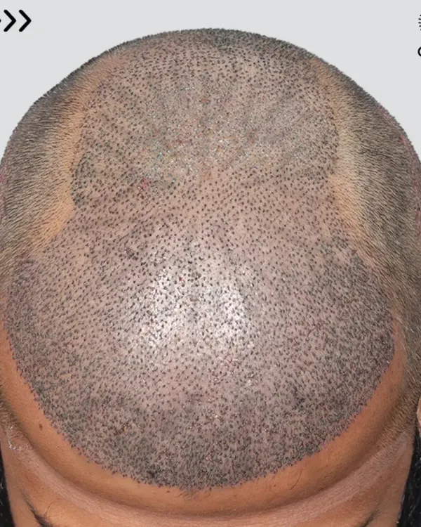 A look at the scalp just after surgery for a Grade 6 case. 5700 grafts were meticulously placed in a single session to recreate the hairline and add density from the frontal area to the crown.