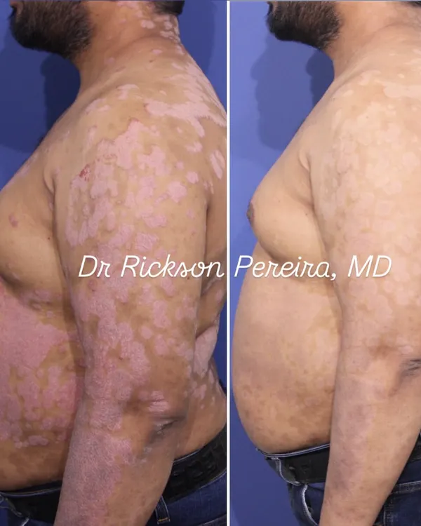 This side view shows the dramatic clearance of psoriasis plaques after just two weeks of biologic therapy. This treatment targets the specific inflammatory cause of the disease, allowing patients to regain confidence and participate in activities they once avoided.