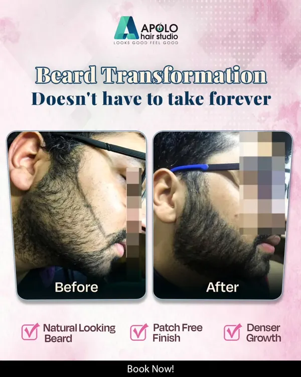 A clear example of a successful beard restoration. The before photo shows significant patchiness on the cheek, while the after photo highlights a dense, patch free finish that looks completely natural.