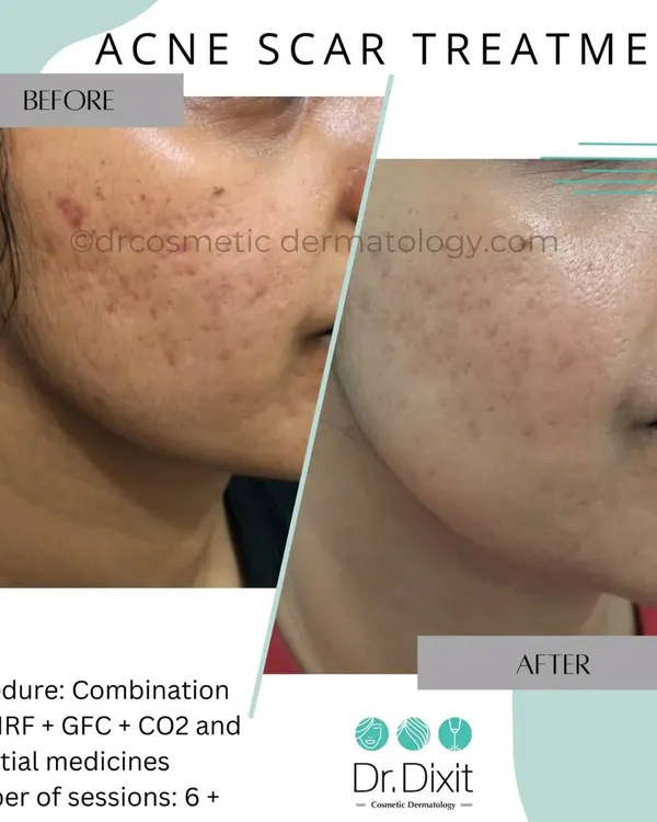 A combination of MNRF, GFC, and CO2 laser helped significantly reduce the depth and texture of these acne scars. This multi-modal approach ensures we address the scars at different levels of the skin.
