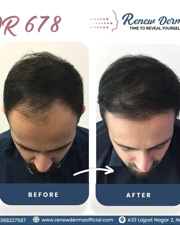 This is what we aim for: real, visible results. This client underwent our QR678 hair therapy and saw a significant improvement in hair density and coverage. This non-surgical treatment is a powerful way to fight hair thinning.