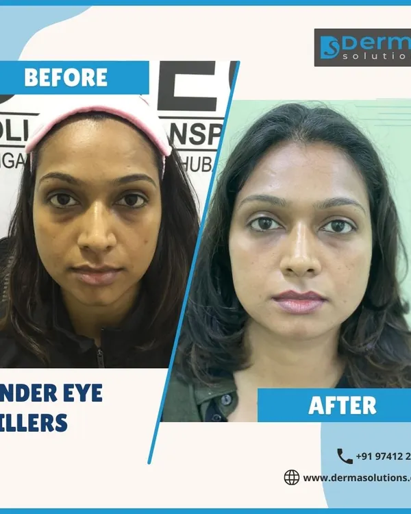 Hollowness under the eyes is a common concern that can make you look tired. Here is a clear example of how I use under-eye fillers to restore volume, smooth the area, and create a naturally refreshed and more awake appearance.