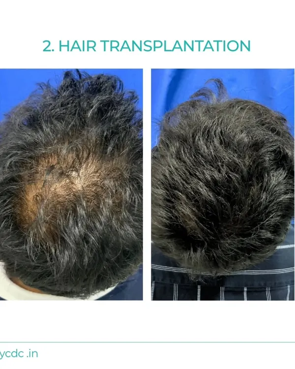 A clear comparison showing significant improvement in hair density on the crown area after a hair transplant procedure. My goal is to fill in thinning areas for a fuller look.