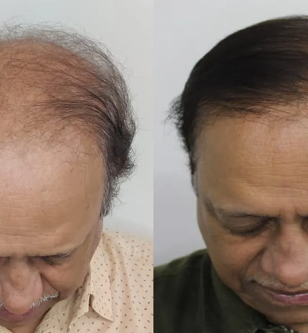 This patient presented with Grade 7 baldness at 64 years of age. This top-down view shows the incredible coverage we achieved, proving that even the most advanced cases can be treated successfully.