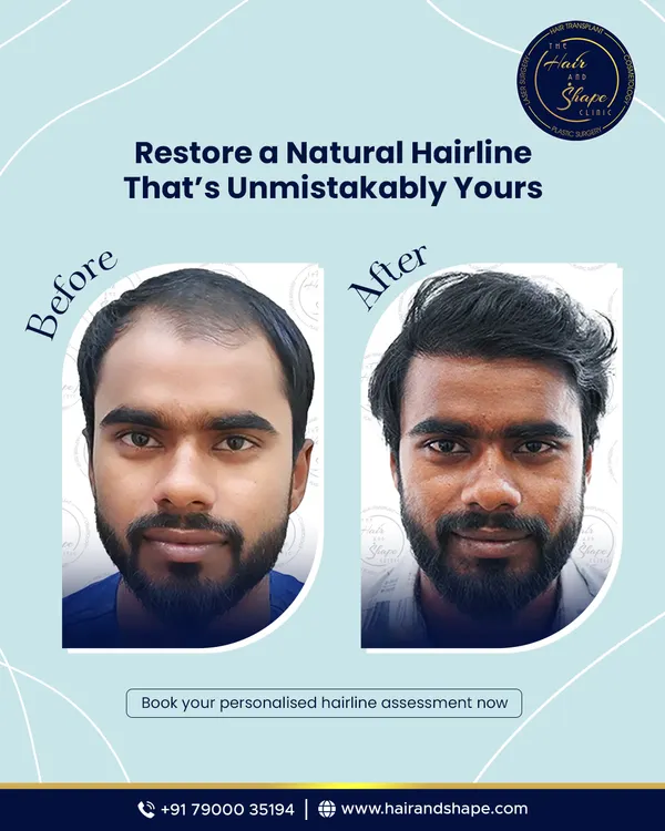 Restoring a natural hairline that is unmistakably yours. This before and after shows a significant improvement in density and a redefined hairline that frames the face naturally.