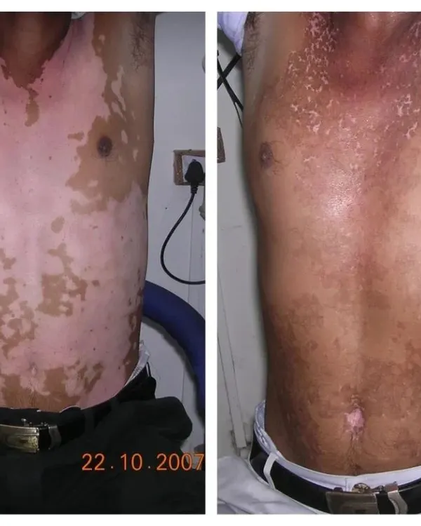 This image shows the kind of results we can achieve. With a consistent and correct treatment plan, it is possible to bring back your natural skin colour and manage Vitiligo effectively.