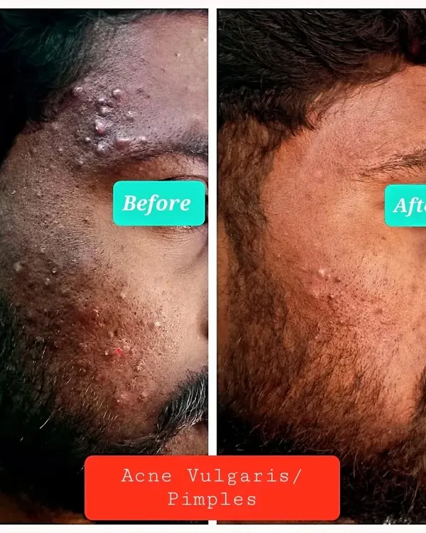 This is a before and after image of a patient I treated for severe Acne Vulgaris, commonly known as pimples. With a personalized treatment plan, we were able to significantly reduce the inflammation and active breakouts, leading to clearer and healthier skin.