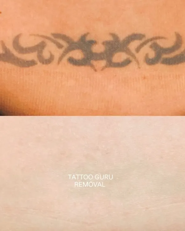 This tribal-style lower back tattoo has been significantly faded. This type of dense black ink work requires patience and several sessions to break down completely.