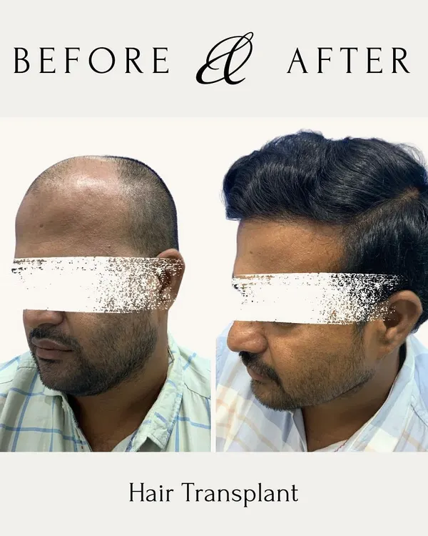 This before and after image shows a complete hair transformation. My focus is on creating a dense, natural-looking result that restores not just hair, but also confidence. This is a permanent solution to hair loss.