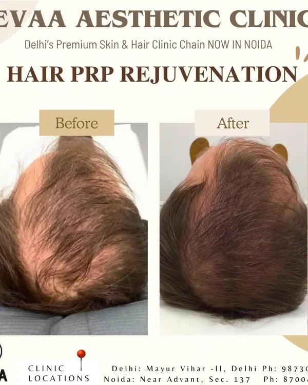 This is the hero item. A compelling before and after comparison showcasing significant hair regrowth and increased density on the crown area for a male client. This result was achieved through our customized Hair PRP Rejuvenation protocol, a non-surgical treatment for androgenetic alopecia.