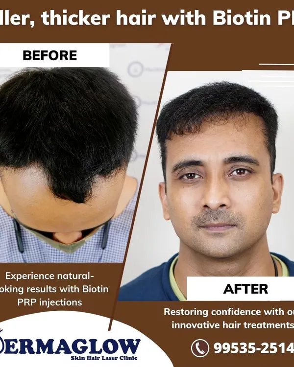 This before-and-after image shows the powerful effect of Biotin PRP injections. The treatment significantly improved hair density and restored the client's hairline, offering a non-surgical path to fuller hair.