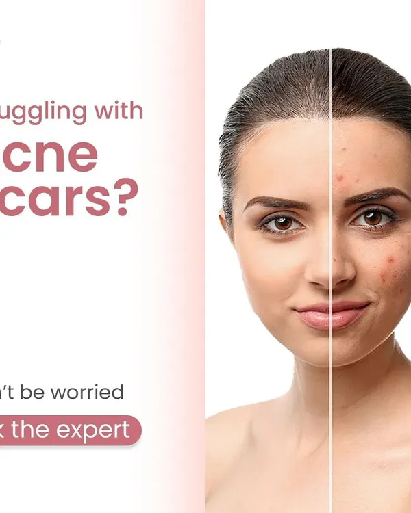 If you are struggling with acne scars, you are not alone. I can help you develop a personalized treatment plan to address your specific concerns and achieve smoother skin.
