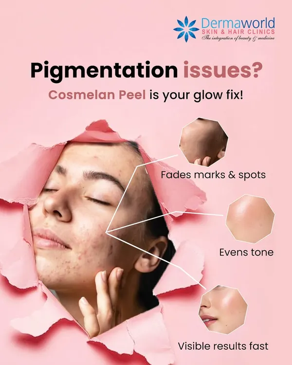 For deep and stubborn pigmentation issues like melasma, the Cosmelan Peel is our go-to solution. This professional-grade treatment works by inhibiting melanin production to fade dark spots and deliver visible results for an even, radiant skin tone.