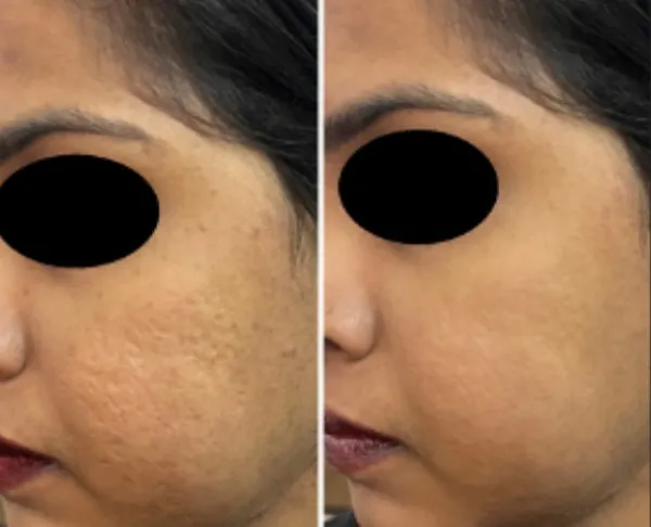 This before and after comparison demonstrates the power of the CO2 laser in treating atrophic acne scars. The patient's skin texture is visibly smoother and the scars are significantly less prominent after completing the recommended course of treatments.