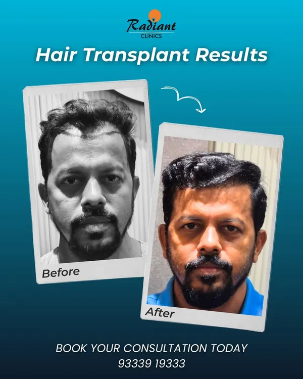 A clear view of a significant transformation. We focused on creating a dense, age-appropriate hairline that restores a youthful frame to the face, leading to a major boost in this patient's confidence.