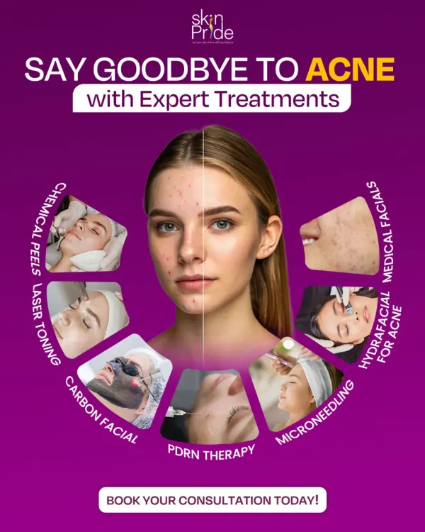 Acne can be frustrating, but we have a range of expert treatments to help. From medical facials and chemical peels to advanced laser therapies, we find the right solution for your specific skin concerns.