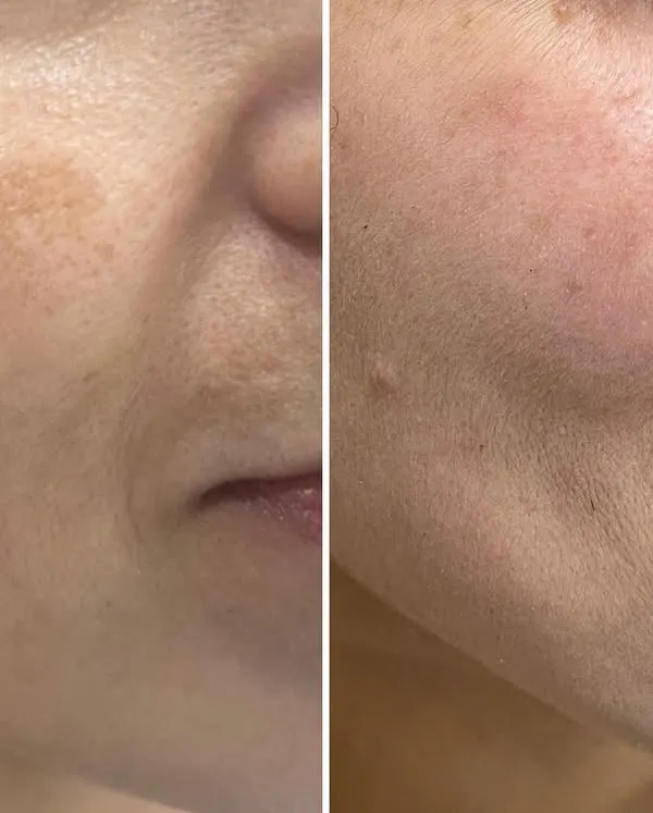 This before-and-after comparison shows a significant reduction in facial hyperpigmentation. We achieved this clearer, more even skin tone through a personalized plan combining in-clinic procedures with a consistent at-home skincare routine.