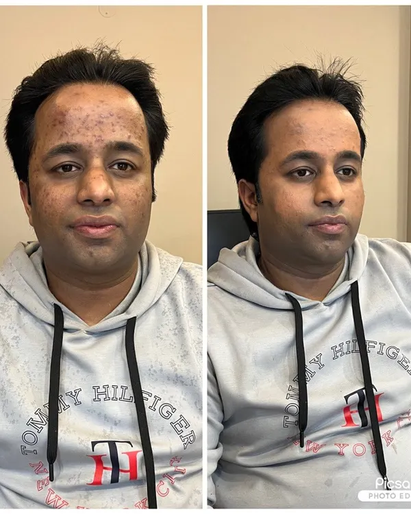 My expertise is creating a natural, clean look. This before-and-after comparison shows how I use corrective makeup techniques to even out skin tone and conceal acne, ensuring you look sharp and confident in person and on camera.