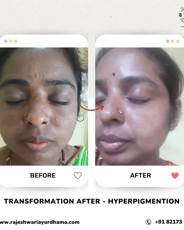 This before and after image shows the significant reduction of hyperpigmentation on the face. My customized Ayurvedic cosmetology treatments target dark spots and melasma, using herbal formulations to restore even skin tone and natural radiance without harsh chemicals.