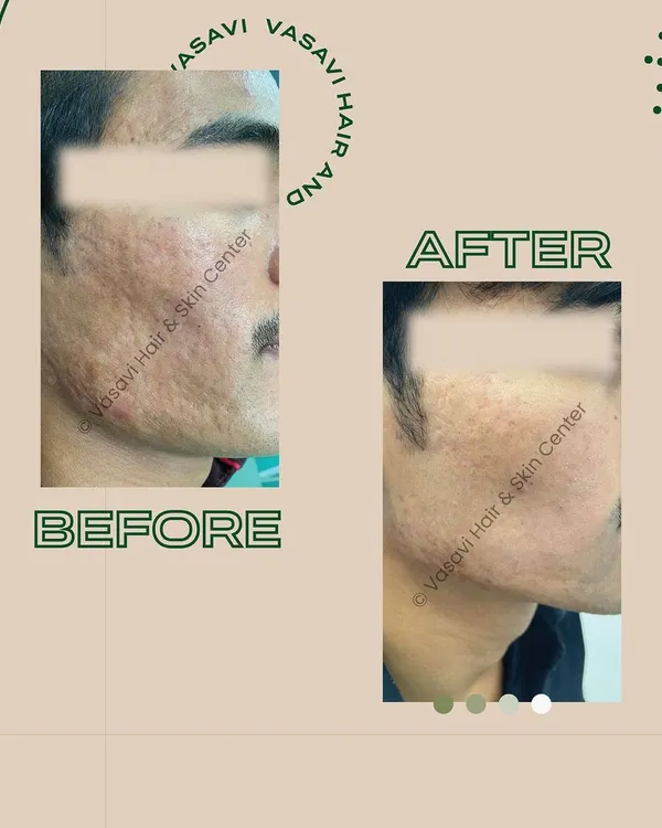 This before-and-after comparison demonstrates the significant improvement possible for deep, textured acne scars. The patient on the left presented with a combination of atrophic scars. Through a personalized treatment plan involving multiple sessions, we achieved the smoother, more even skin texture you see on the right, restoring both the skin's surface and the patient's confidence.