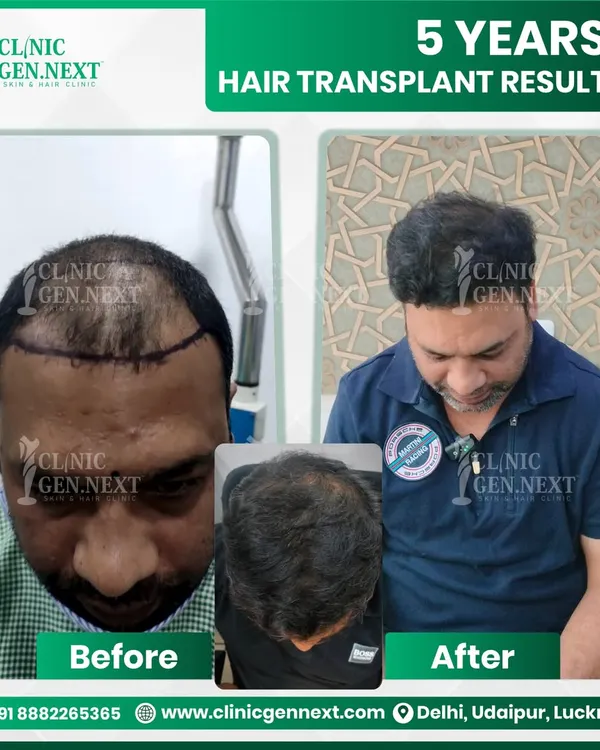 This result after 5 years shows the longevity and natural direction of the hair we achieve. The coverage on the crown is mature and blends perfectly, which is crucial for a real-world, authentic look.