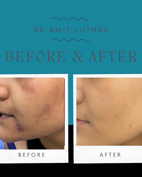 Unsightly acne scars don't have to be permanent. This before and after shows the significant improvement in skin texture and scar reduction possible with my tailored resurfacing treatments.