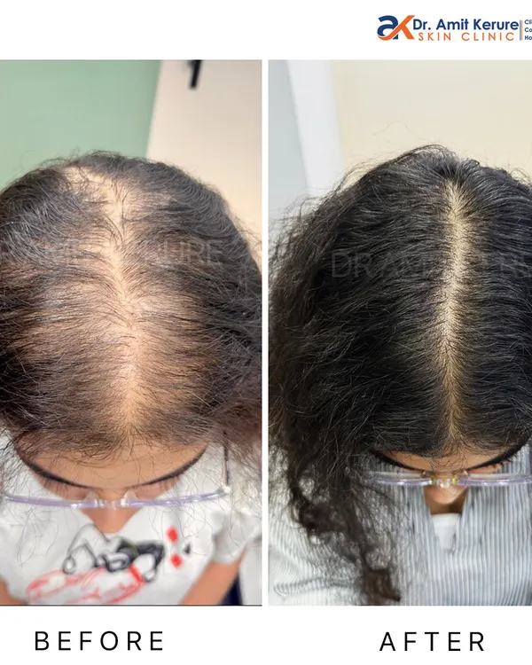 This before-and-after image shows a significant improvement in hair density for a female patient. This result was achieved with non-surgical treatments that stimulate dormant hair follicles, effectively reversing the signs of thinning.