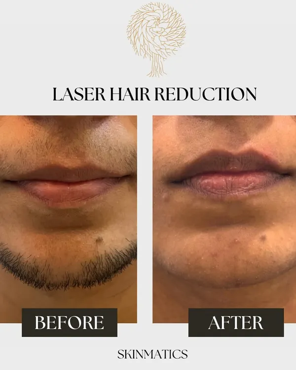 This is the power of precise, medical-grade laser hair reduction. This before and after image shows the significant reduction of coarse hair on the chin and upper lip, resulting in smooth, clear skin without the irritation of shaving or waxing.