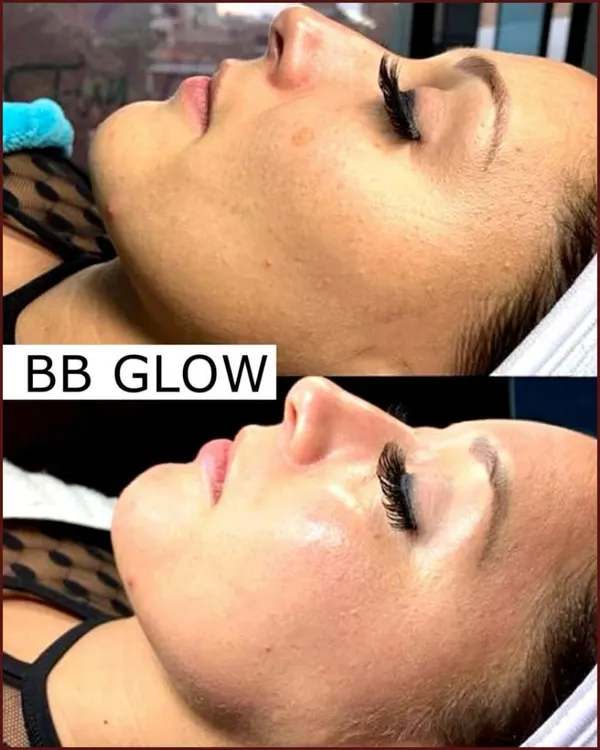 A clear demonstration of the BB Glow effect. Notice how the skin tone becomes more even, redness is reduced, and the overall complexion is brighter and more luminous after the treatment.