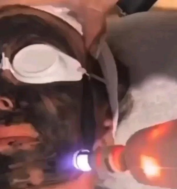 This is a close-up of a Carbon Laser Peel, a procedure I use to treat acne pigmentation, melasma, and enlarged pores. The laser interacts with the carbon paste to exfoliate the skin and even out its tone.