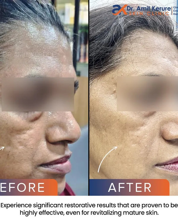 A side profile view showing significant improvement in deep skin scars and overall texture after a combined CO2 laser and MNRF session. This demonstrates the restorative results possible even on mature skin.