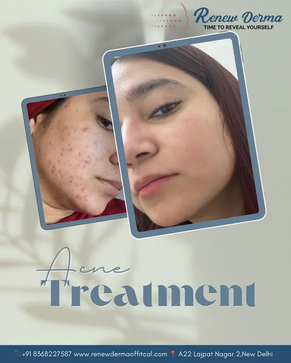 This is why I do what I do. Seeing a client's journey from dealing with persistent acne to revealing clear, healthy skin is the ultimate reward. This transformation was achieved through a consistent, customized plan that targeted both active acne and scarring.