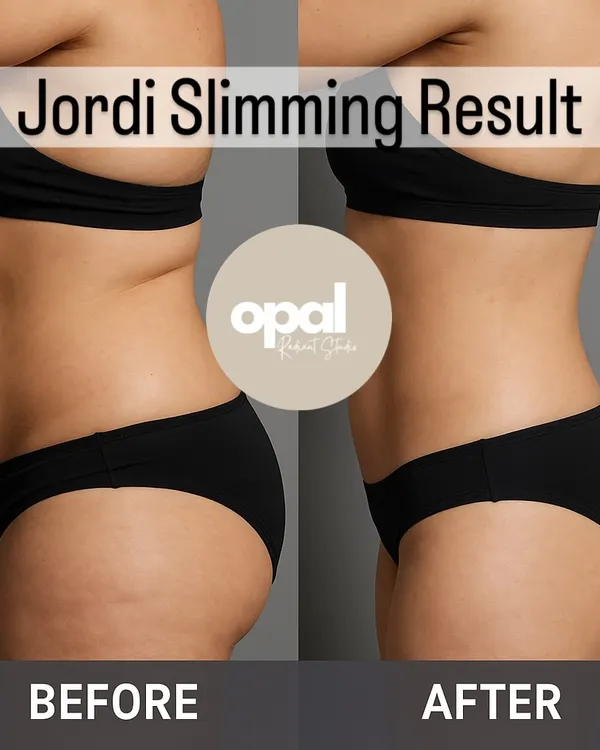 This is the kind of transformation possible with our Jordi Shape treatment. This client was thrilled to see a significant reduction in stubborn belly fat and a more contoured, smoother waistline. This result was achieved without any surgery, focusing on a safe and gradual slimming process.
