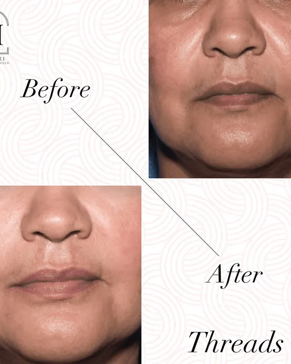 This before and after image shows the subtle yet effective lift achieved with threads. Notice the improvement in the lower face and the softening of lines around the mouth for a rejuvenated look.
