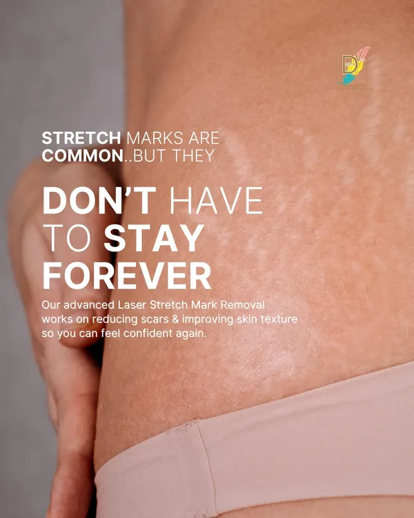 Stretch marks are common, but they don't have to be permanent. Our advanced laser treatments work on improving skin texture and reducing the appearance of scars, whether they are from weight changes, pregnancy, or other factors.
