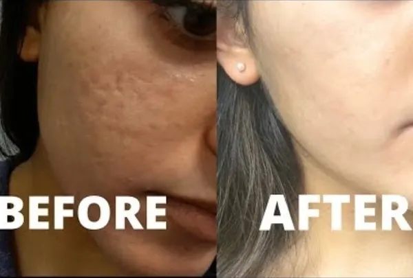 This before and after image shows the significant improvement in skin texture and reduction of deep acne scars for one of my patients. Using Fractional CO2 laser technology, I can resurface the skin, promote collagen growth, and achieve a smoother, more even complexion.