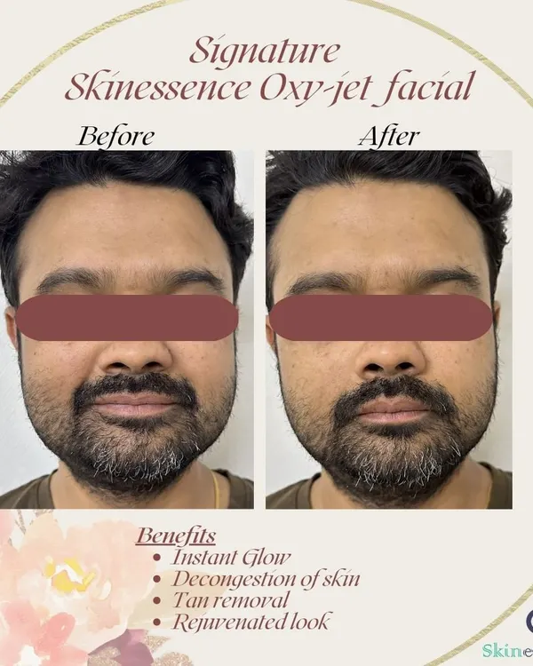 This client wanted to tackle dullness and tan. The before-and-after photos show the immediate brightening and rejuvenating effect of my signature Oxy-jet Medi-facial, which left his skin looking visibly refreshed and glowing.