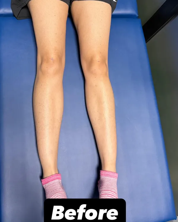 This "before" image shows significant quadriceps atrophy following an ACL and meniscus injury. This muscle loss is a common consequence of such injuries and is the starting point for our targeted rehabilitation process.