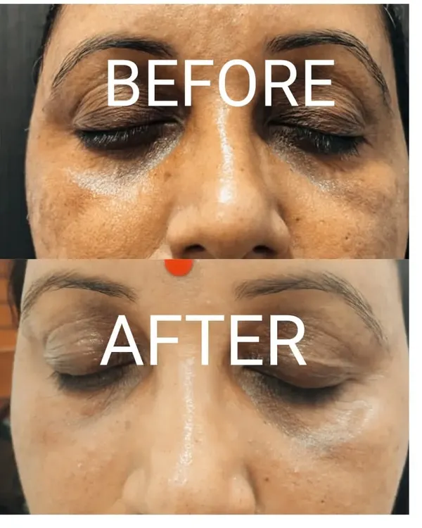A dramatic reduction in under-eye pigmentation and fine lines after a personalized Dermafrac treatment plan. This shows how I target stubborn dark circles to reveal brighter, more youthful eyes.