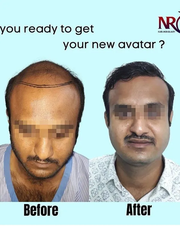 A clear comparison showing a client before his procedure and after, with a full, natural hairline. This result was achieved with a high-density Micro-FUE hair transplant to address Norwood Grade 7 baldness.