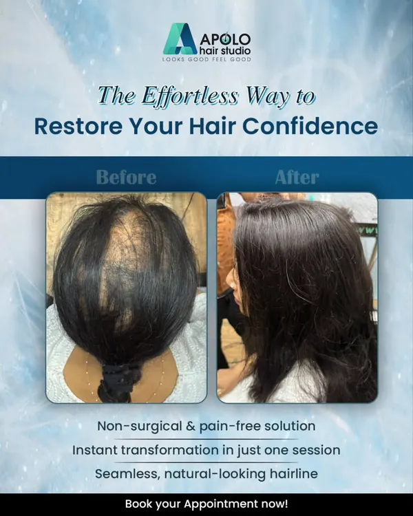 This is a perfect example of our hair topper for women. It provides an effortless, non-surgical solution to hair thinning, delivering an instant transformation with a seamless, natural-looking hairline.