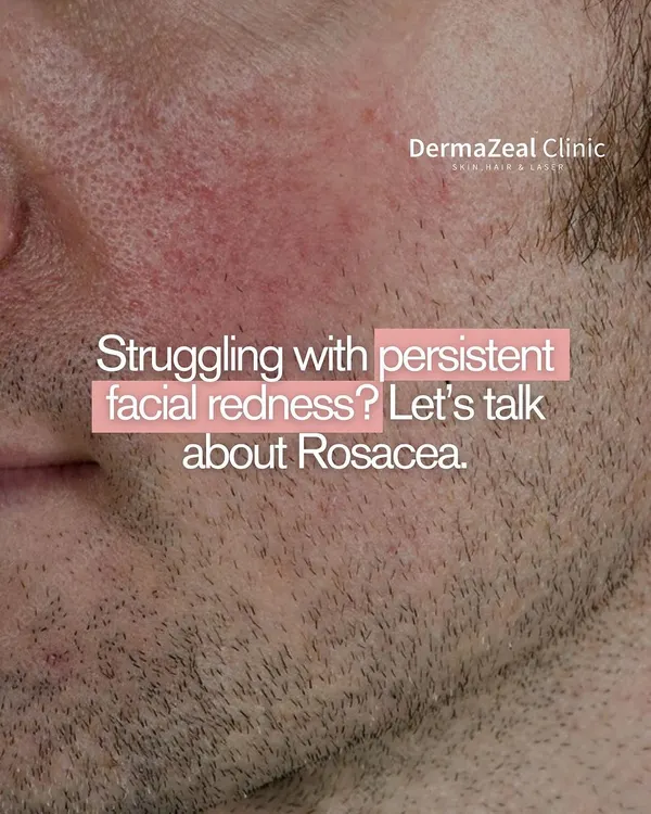 If you are struggling with persistent facial redness, it is important to consider that it might be Rosacea. This condition requires a specific approach to management and treatment, which starts with a professional diagnosis.