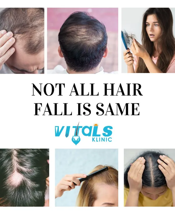 It is crucial to understand that not all hair fall is the same. This image collage shows different patterns of hair loss in men and women, emphasizing that the cause can range from genetic balding to diffuse thinning. A correct diagnosis is key to finding the right treatment.