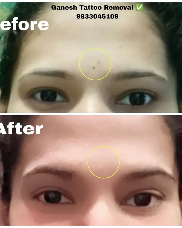 A clean before-and-after result of a permanent bindi tattoo removal. My goal is always to restore your skin, giving you a fresh start.
