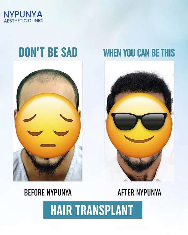 (Hero Media) This is the transformation that’s possible. On the left is the frustration of dealing with advanced hair loss, and on the right is the confidence that comes with a permanent, natural-looking solution. A hair transplant isn't about changing who you are; it's about feeling like yourself again.