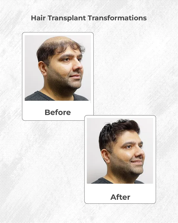 A side-profile view showing a significant hair transplant transformation. This patient regained not just his hairline but also his confidence. The 'after' photo highlights the density and natural flow of the newly grown hair.
