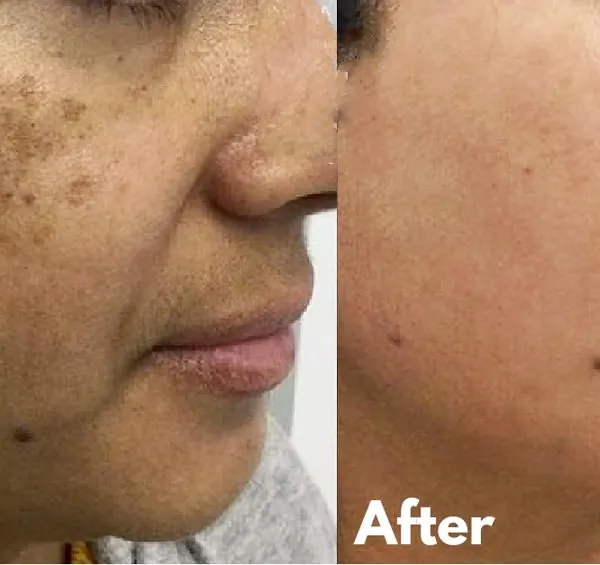 This is a powerful before-and-after of a patient with significant melasma. My treatment plan focused on a combination of advanced laser toning and a strict sun protection regimen to achieve this clear, even-toned result.